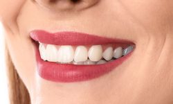 teeth-after teeth-after